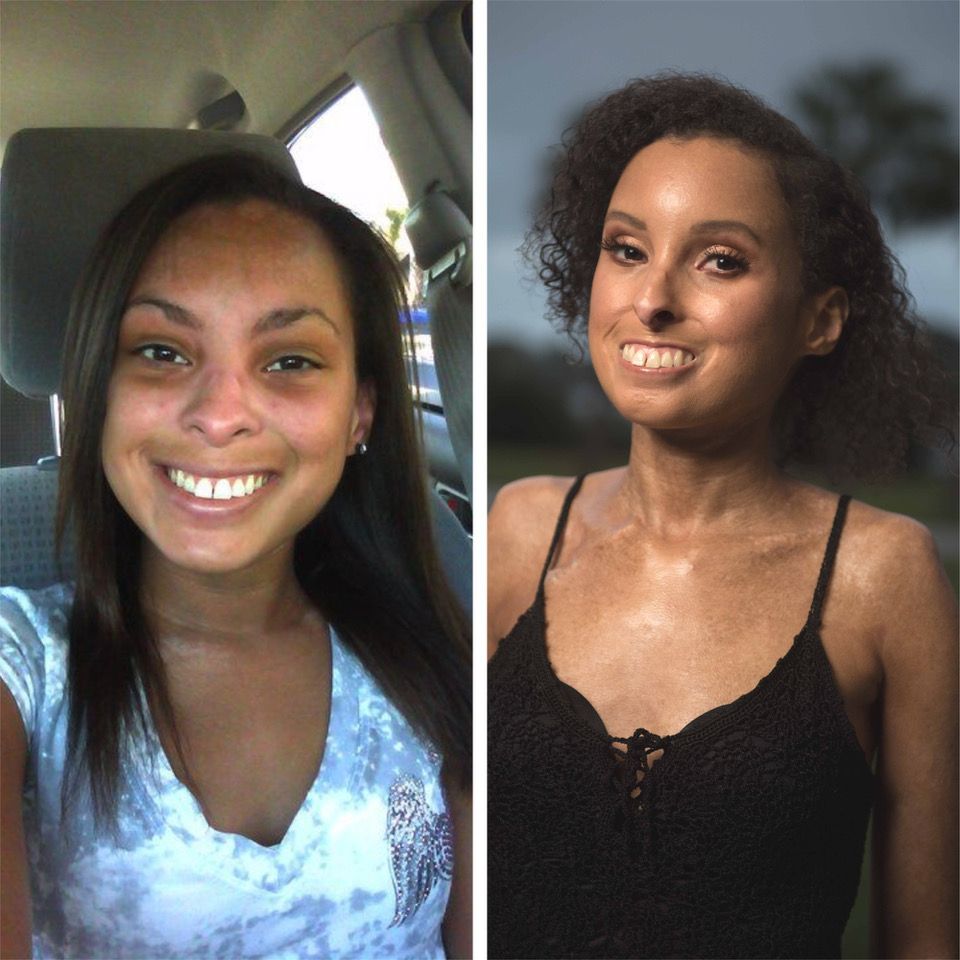 Jessica, a person with scleroderma, smiling in a before and after photo