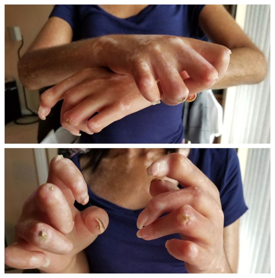 Jessica displays her hands showing how scleroderma impacts her ability to straighten her hands