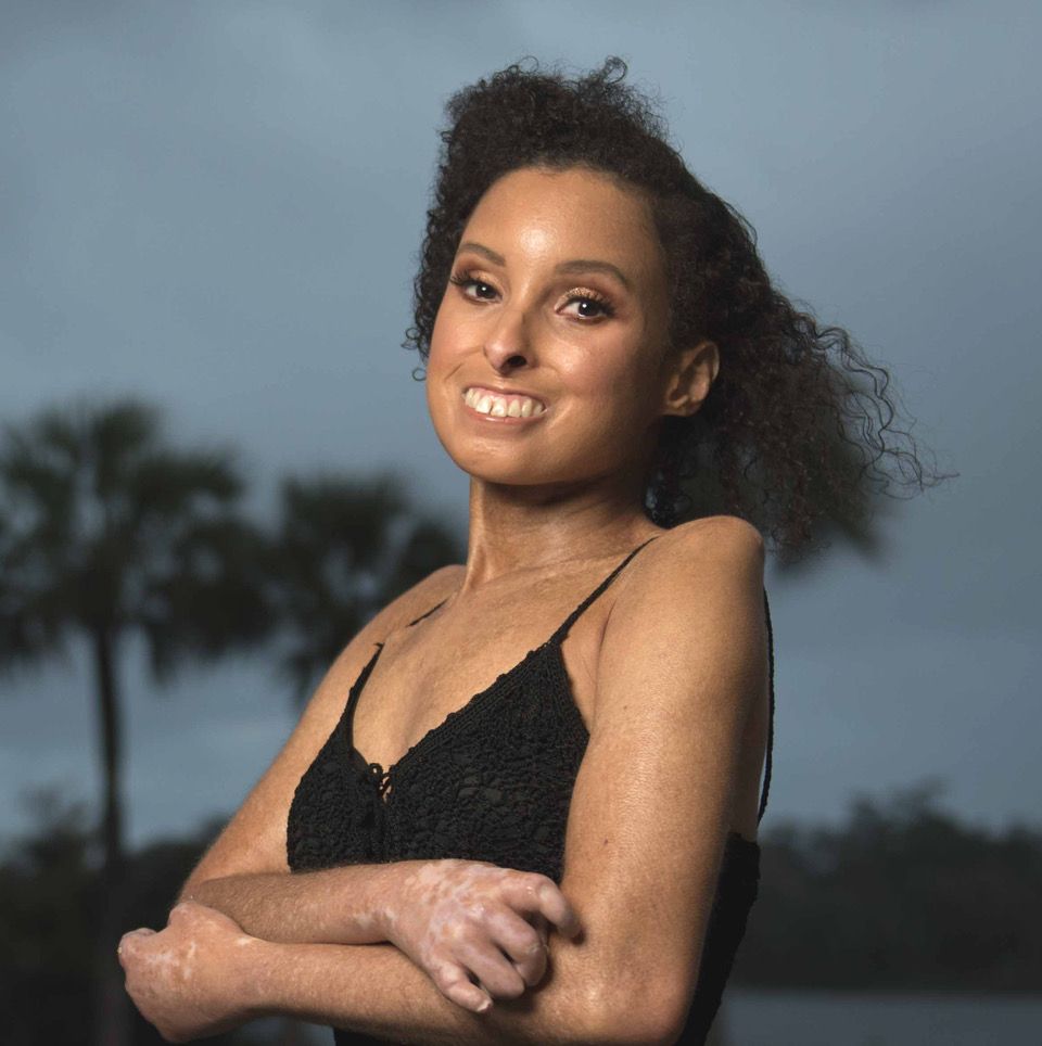 Woman with Scleroderma (Jessica) standing on the beach. Wind is blowing through her hair, smile radiates across her face